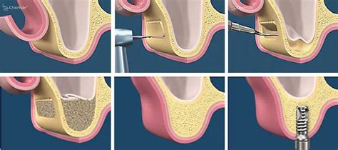 Sinus Lift .